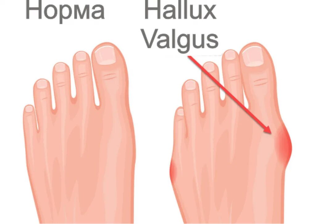 Кость сбоку на большом пальце. Почему болит палец сбоку. Вросший ноготь на большом пальце стопы. Косточка около большого пальца ноги. Болит большой палец на ноге при ходьбе сбоку.