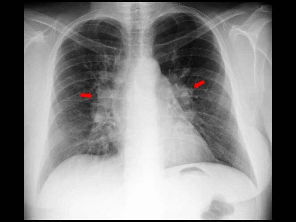 Лимфаденопатия средостения легких. Саркоидоз внутригрудных лимфатических узлов рентген. Саркоидоз внутригрудных лимфоузлов рентген. Саркоидоз лёгких на рентгене. Лимфаденопатия средостения рентген.