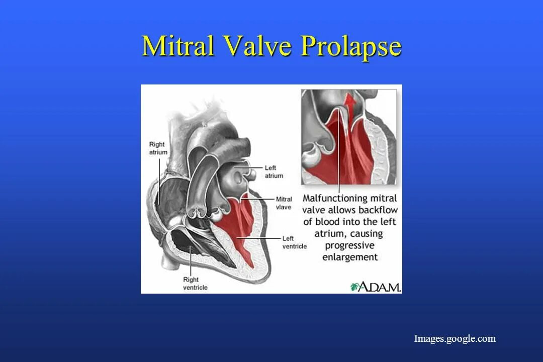 Что такое пролапс митрального клапана. Пролапс митрального клапана.