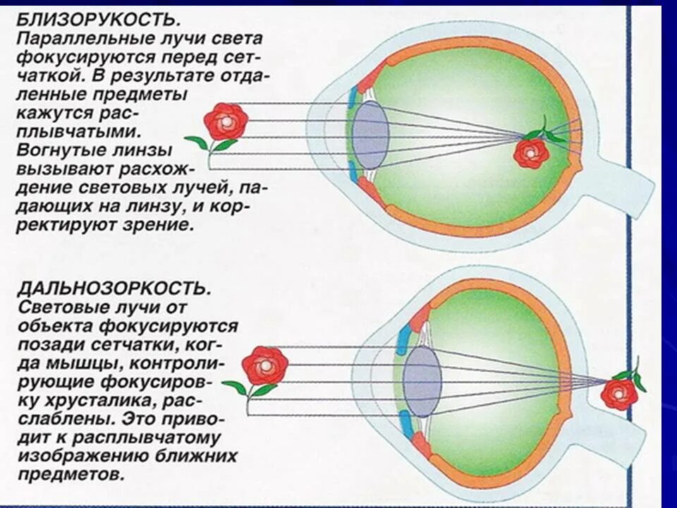 Миша страдает близорукостью а его брат дальнозоркостью. Анатомия глаза близорукость и дальнозоркость. Строение глаза человека близорукость. Глаз дальнозоркость и близорукость. Зрение близорукость и дальнозоркость.