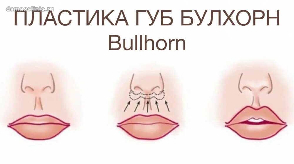 Напряжена верхняя губа