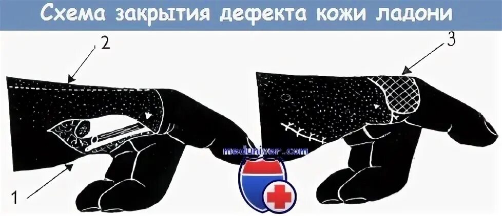 Закрытие дефекта