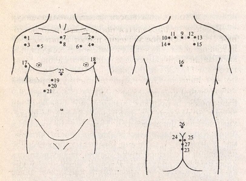 невралгия пиявки. невралгия пиявки. гирудотерапия схема постановки пиявок при остеохондрозе. брошюра гирудотерапия. точки при межреберной невралгии.