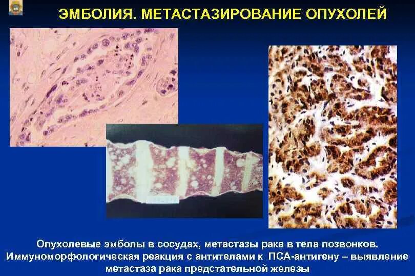 Метастазы распространение