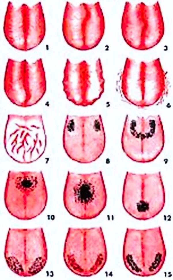 Язык признак какой болезни. Десквамативный глоссит складчатый.