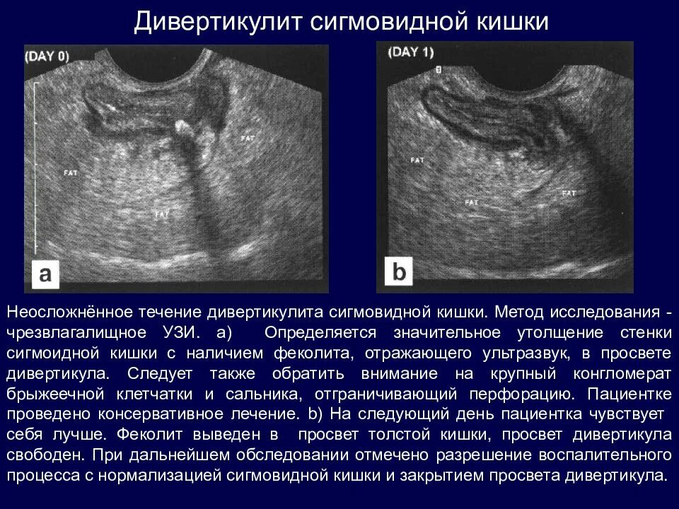 Дивертикул кишечника по УЗИ. Дивертикулярная болезнь УЗИ. Воспаление кишечника на УЗИ. Образование кишечника на УЗИ. Узи кишечника как подготовиться