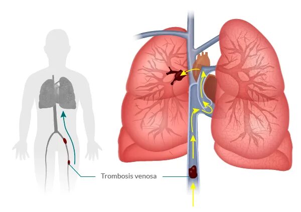 Тромбоэмболия легочной артерии. Эмболия тромбом легочной артерии. Оторвался тромб в легких