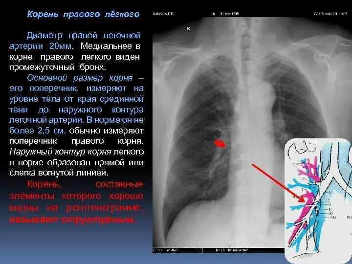 Образования в легких человека. Корень легкого анатомия рентген. Рентген анатомия ОГК. Левый корень легкого рентген. Корень легкого на рентгенограмме.