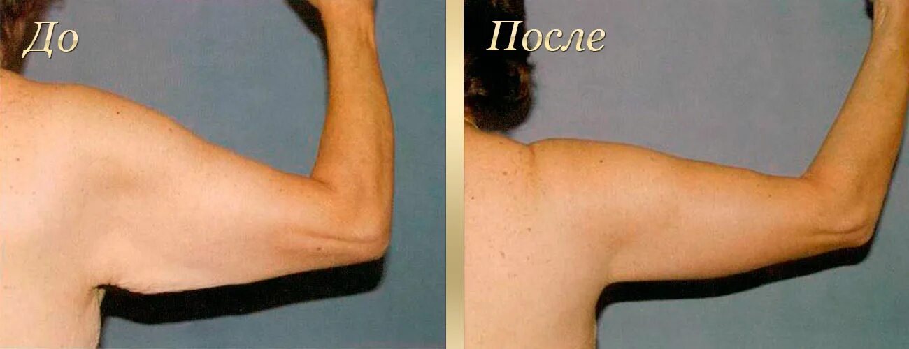 как убрать кожу на руках