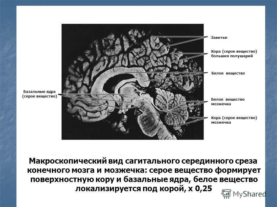 мозолистое тело, белое вещество и серое вещество. полосатое ядро головного мозга. схема базальных ядер головного мозга. поперечный срез головного мозга анатомия. строение конечного мозга мозолистое тело.