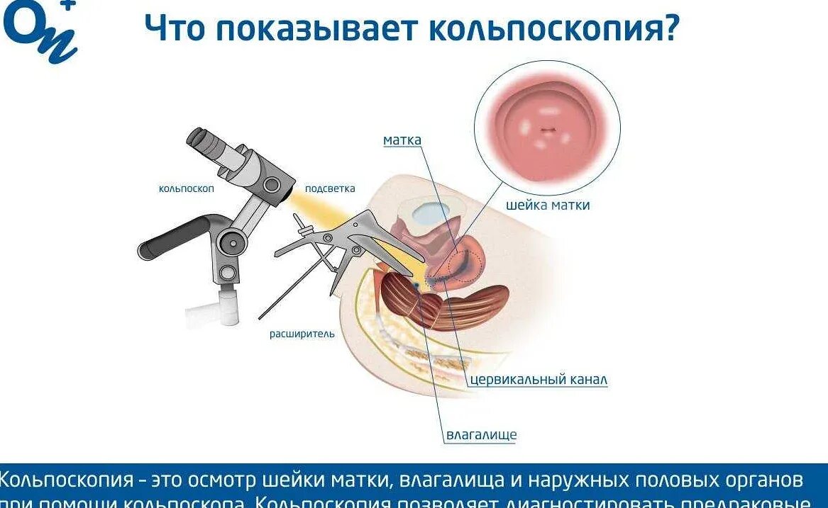 Как выглядит кольпоскопия шейки матки. Как выглядит кольпоскопия шейки матки