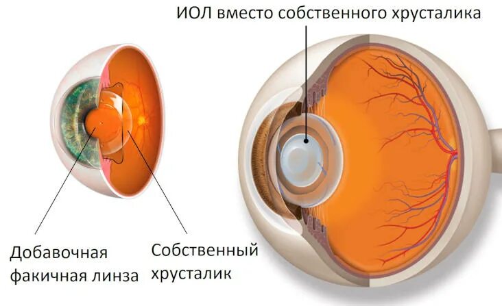 Как меняется хрусталик глаза. Замена глазного хрусталика. искривление хрусталика. рефракционная замена хрусталика. искривление хрусталика глаза.