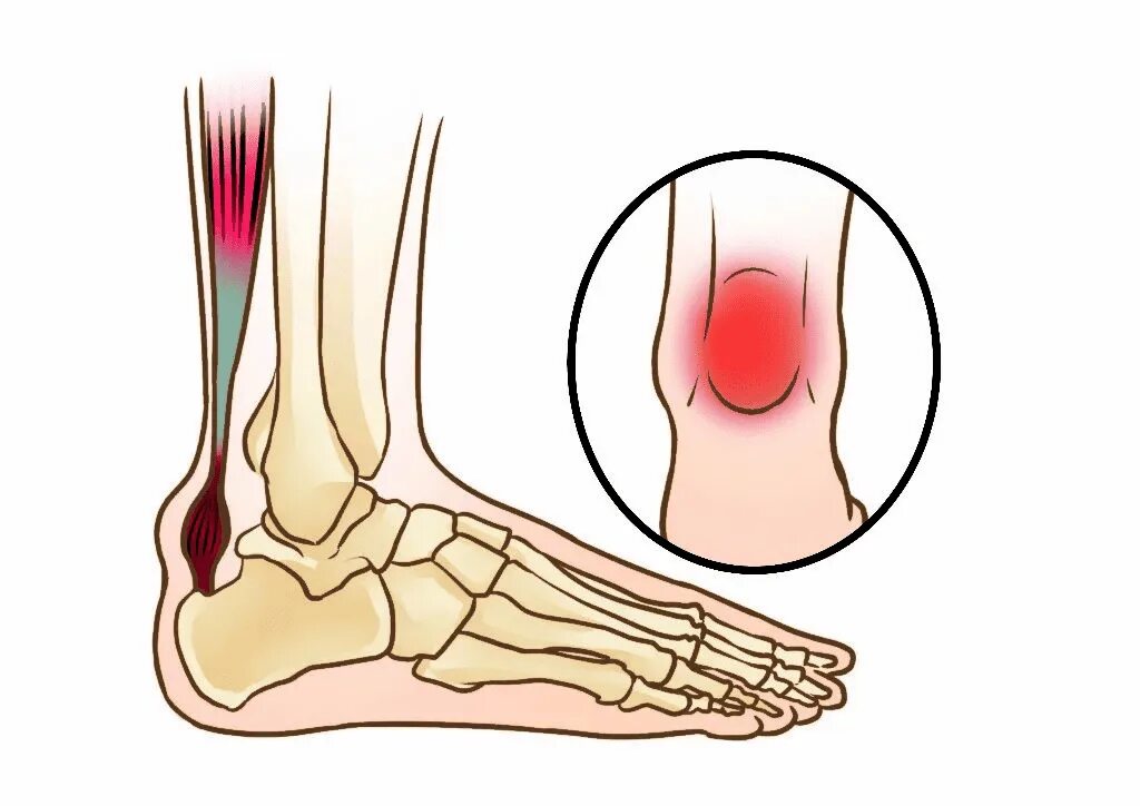 Тендиноз ахилиллого сухожилия. Тенгевит ахилового сухожилия. Воспаление ахиллова сухожилия (тендинит). Тендинита ахиллова сухожилия. Бег болит пятка