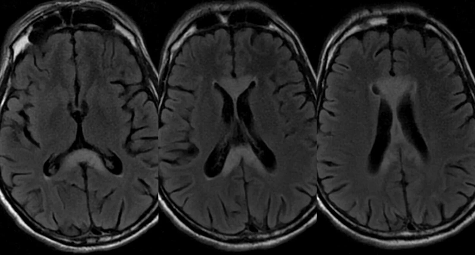 Ишемия мозга мрт. Лейкоареоз головного мозга мрт. Лейкоареоз на кт. Перивентрикулярный лейкоареоз мрт. Перивентрикулярная лейкомаляция мрт.