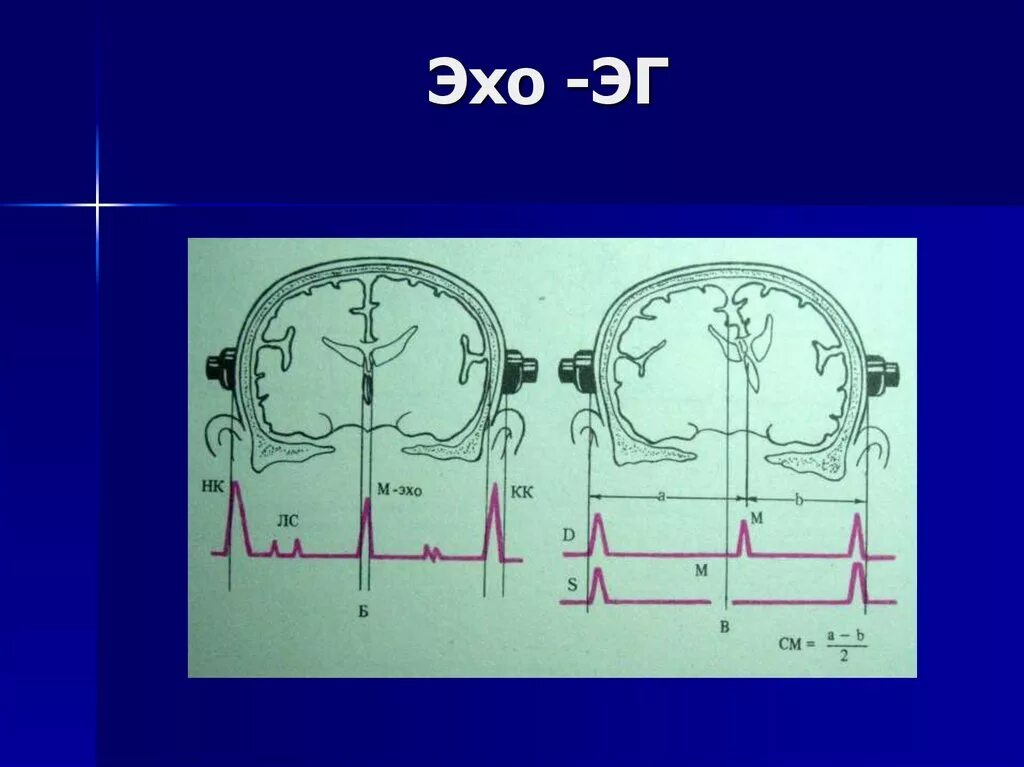 Эхо гостомеля. Эхоэнцефалоскопия головного мозга норма. Эхо ЭГ. Одномерная эхоэнцефалография. Эхоэнцефалоскопия (Эхо-ЭГ).