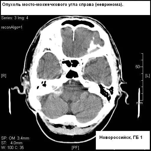 Невринома мосто-мозжечкового угла кт. Опухоль мостомозжечкового угла кт. Мосто-мозжечковый угол мрт. Опухоли мостомозжечкового угла мрт. Мозжечковая опухоль