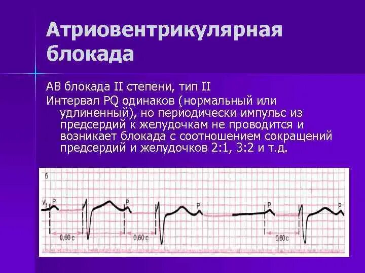 Атриовентрикулярная блокада 2. АВ блокада 2 степени PQ. АВ блокада интервал PQ. Удлинение интервала PQ на ЭКГ. Удлиненный интервал PQ на ЭКГ.