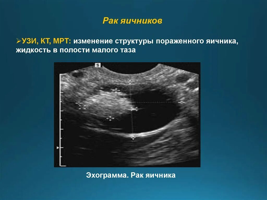 Новообразование яичника УЗИ. Объемные образования яичников на УЗИ. Развитие рака яичников