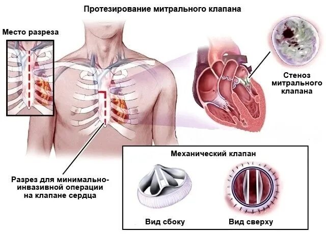 Реабилитация после замены клапана