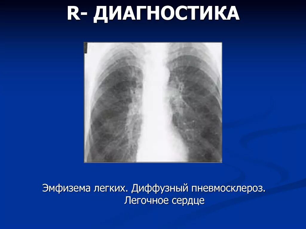 Диффузный пневмосклероз это рак. Диффузный пневмофиброз легких рентген. Постпневмонический пневмосклероз. Посттуберкулезный пневмофиброз.