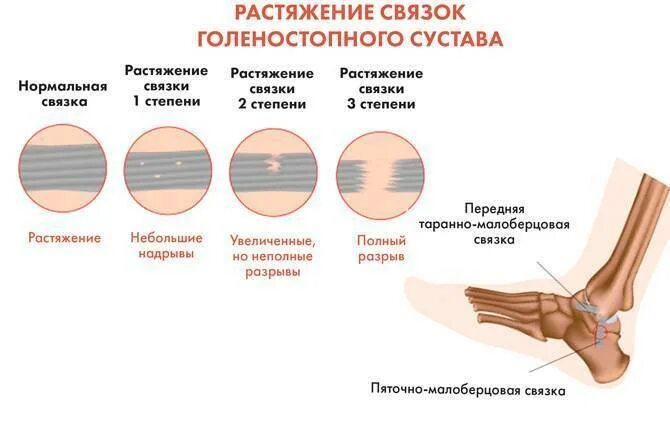 Степени повреждения голеностопных связок. Травма голеностопного сустава растяжение связок. Повреждение связок 1 степени голеностопного. Разрыв связки третьей степени голеностопного сустава.