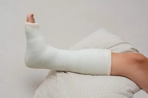 Фото девушек в гипсе нога