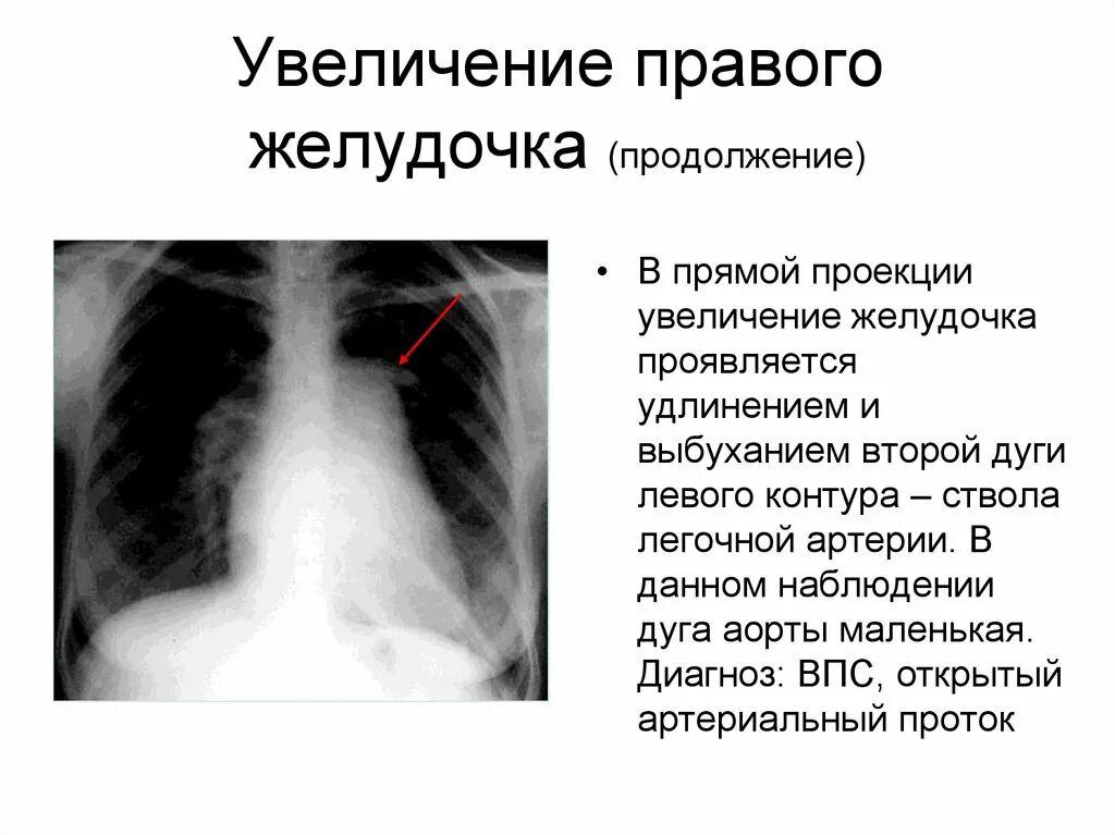 Дилатация правых отделов. Гипертрофия правого желудочка рентген. Увеличение правого желудочка. Увлечение правого желудочка. Гипертрофия сердца на рентгене.