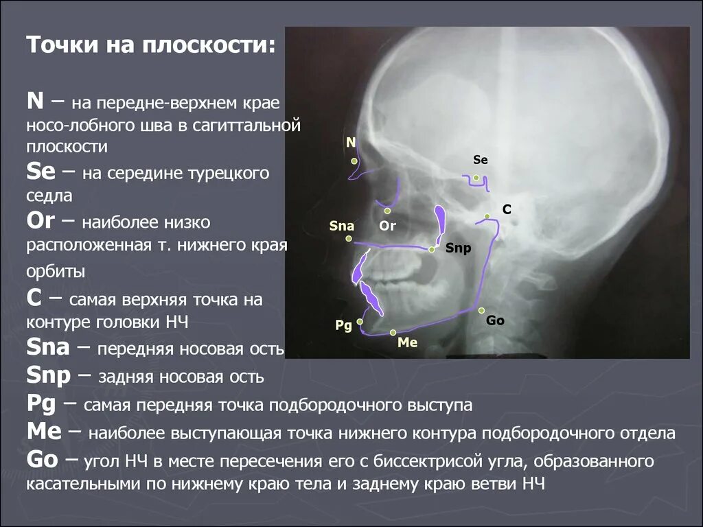 Телерентгенограмма черепа (ТРГ). ТРГ черепа в боковой проекции. ТРГ аксиальная проекция. Анализ ТРГ В боковой проекции.