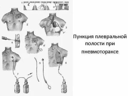 Прокол при пневмотораксе
