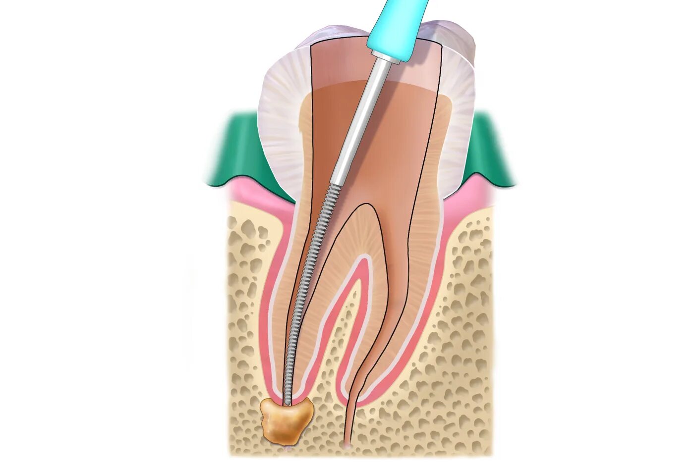 Root canal. Перепломбировка каналов зуба.