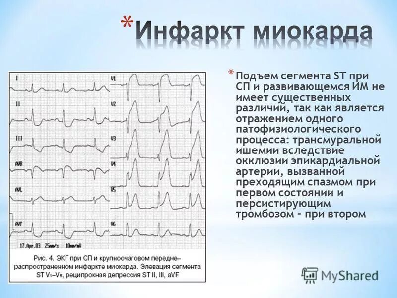 Экг подъем