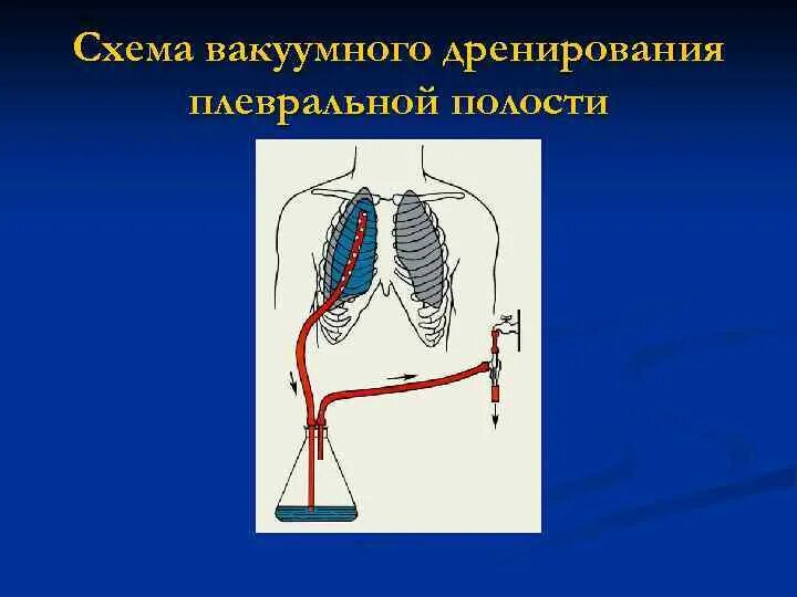 Дренаж Бюлау. Дренаж плевральной полости Бюлау. Пассивное дренирование Бюлау. Пункция плевральной полости по Бюлау.