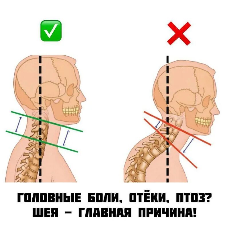 посттравматический миозит. боль в спине. заспазмированная мышца шеи. спазм шейной мышцы лечение. боль в мышцах.