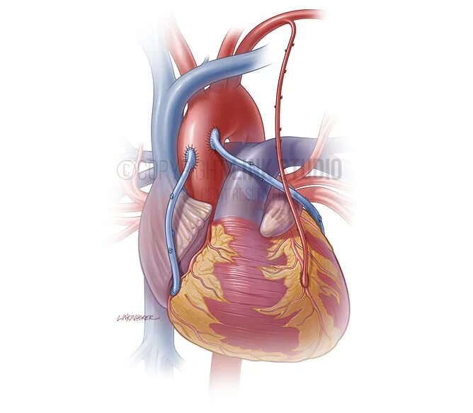 Операция коронарный сосуд. Аорта коронарное шунтирование. Операция шунтирование сосудов сердца.  Аорто-коронарное шунтирование (АКШ.