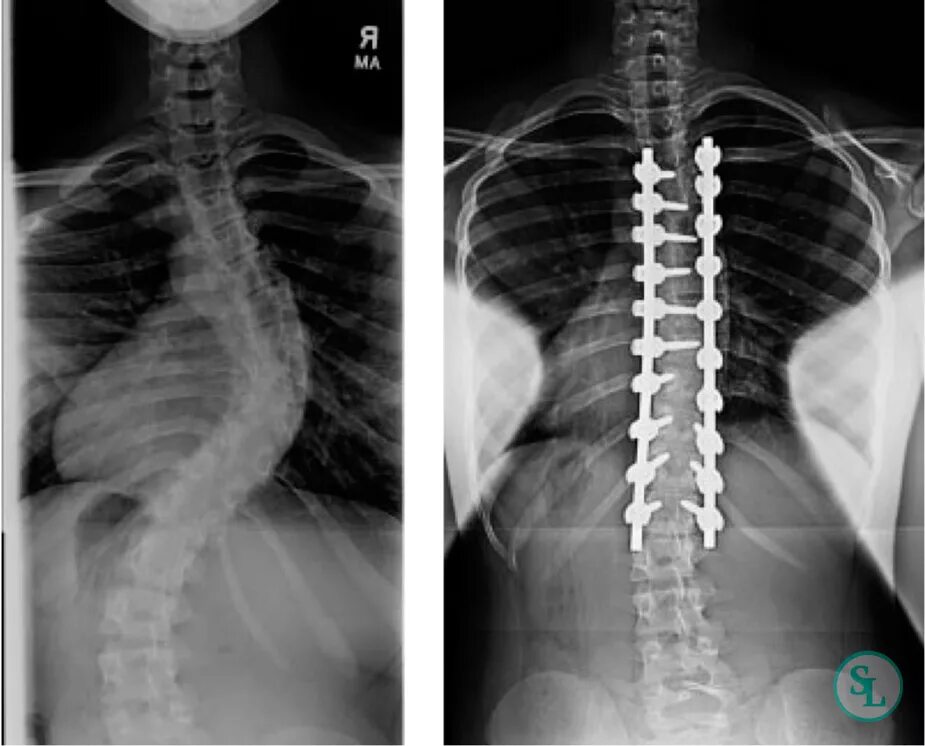 Операция Харрингтона сколиоз. Сколиоз позвоночника 4 степени после операции рентген. 2-Х пластинчатый эндокорректор рентген. Кифосколиоз грудного и поясничного отдела позвоночника. Конструкция позвоночника операция