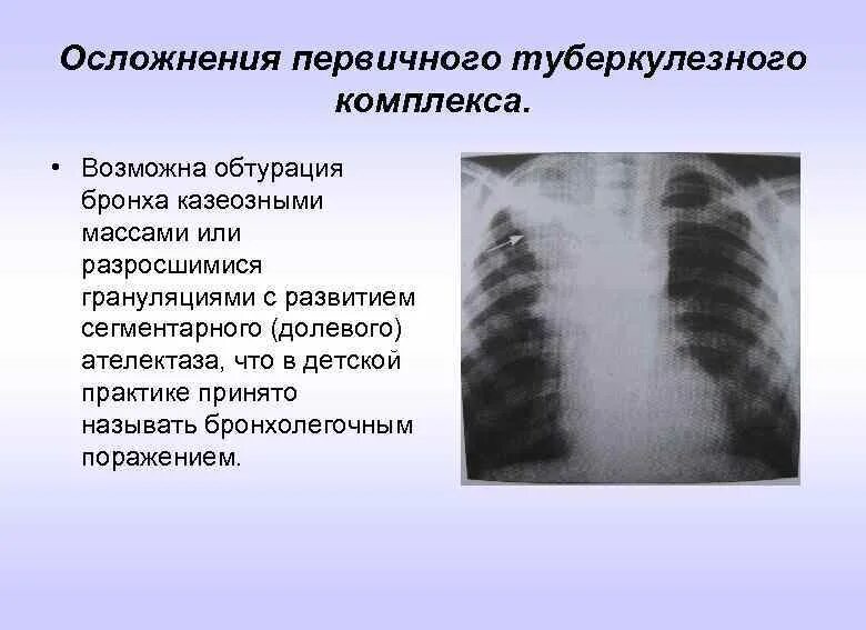 Бронхоаденит это