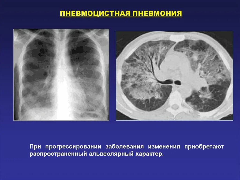 Пневмоцистная пневмония на кт при вич. Пневмоцистная пневмония кт. Пневмоцистная пневмония на кт легких. Пневмоцистная пневмония при вич инфекции. Цитомегаловирусная пневмония на кт.
