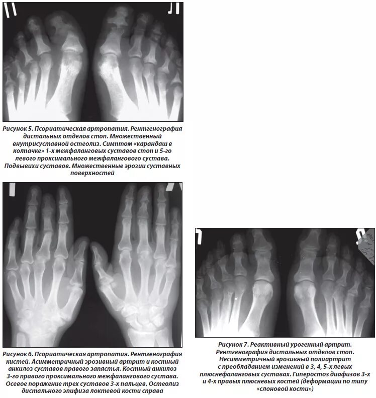 Ревматоидный артрит молоткообразная. Артроз дистальных суставов. Полиостеоартроз гебердена. Артроз плюснефалангового сустава рентгенография. Артроз дистальных суставов.