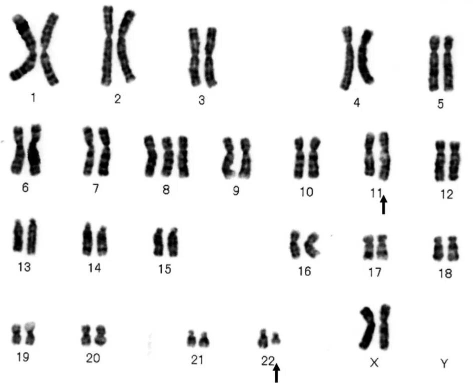 Трисомия 22 хромосомы кариотип. Синдром Варкани кариотип. Синдром трисомии х хромосомы кариотип. Трисомия 8 хромосомы кариотип. Удвоение генов в хромосоме