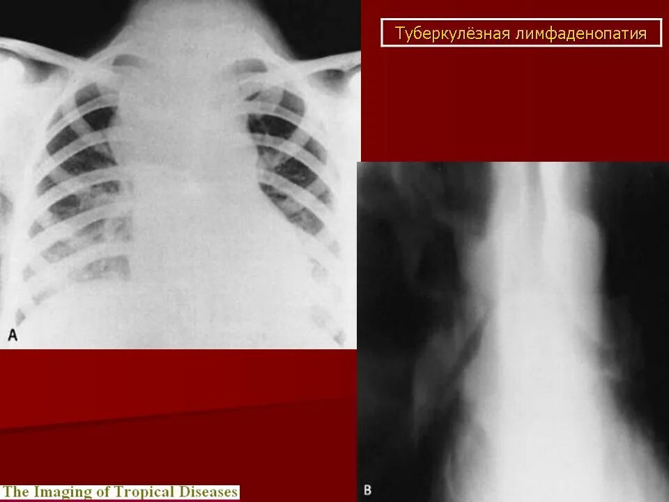 Внутригрудная лимфаденопатия рентген. Туберкулез лимфаденопатия. Лимфаденопатия на рентгене легких. Лимфоаденопатия внутригрудных узлов. Как лечить внутригрудную лимфаденопатию