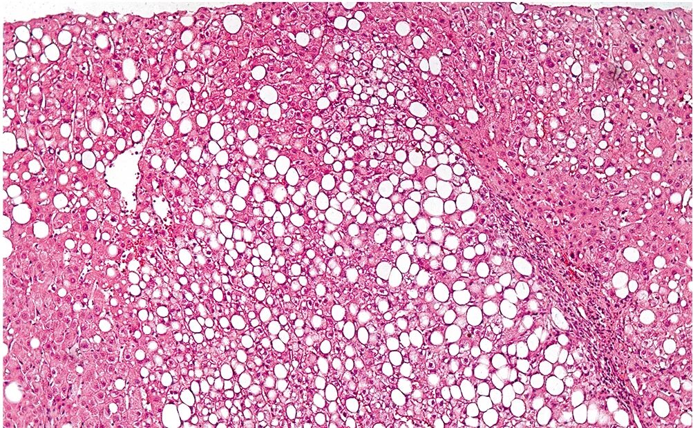 Мелкоузловой цирроз гистология. Алкогольный цирроз печени микропрепарат. Стеатоз печени патанатомия. Аутолиз поджелудочной железы гистология. Что такое стеатоз поджелудочной железы