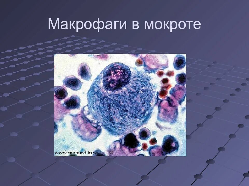 Макрофаги что это. Пенистые макрофаги гистология. макрофаги микробиология. альвеолярные макрофаги. альвеолярные макрофаги в мокроте.