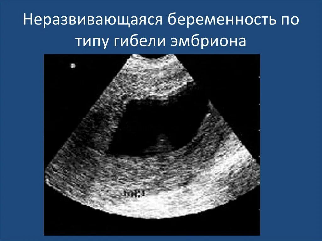 Замершая беременность признаки на ранних сроках. Неразвивающаяся беременность УЗИ. Не развивающая беременность. Неразвивающаяся беременность по типу гибели эмбриона. Не рвзвивающая беременность.