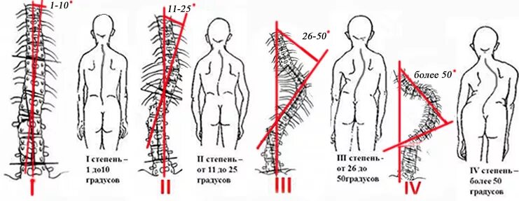 Сколиоз 8 степени. Сколиоз позвоночника 1 степени по чаклину. сколиоз позвоночника с искривлением 17 градусов. сколиоз 2 степени угол искривления 17. угол отклонения позвоночника при сколиозе.