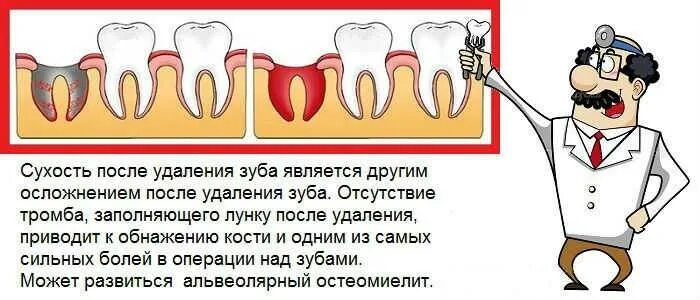 Можно ли после удаления зуба пить кофе. Кровяной сгусток на месте удаленного зуба. Кровный сгусток в лунке удаленного зуба.