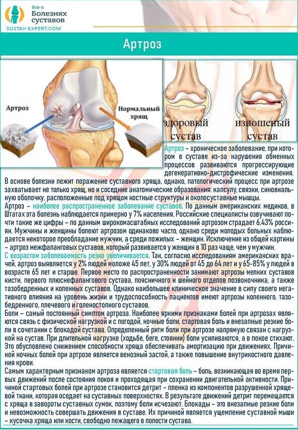 Стартовые боли в коленном суставе. Исследования при артрозе. Характер боли при артрозе коленного сустава. Повреждение мениска коленного сустава дифференциальный диагноз.