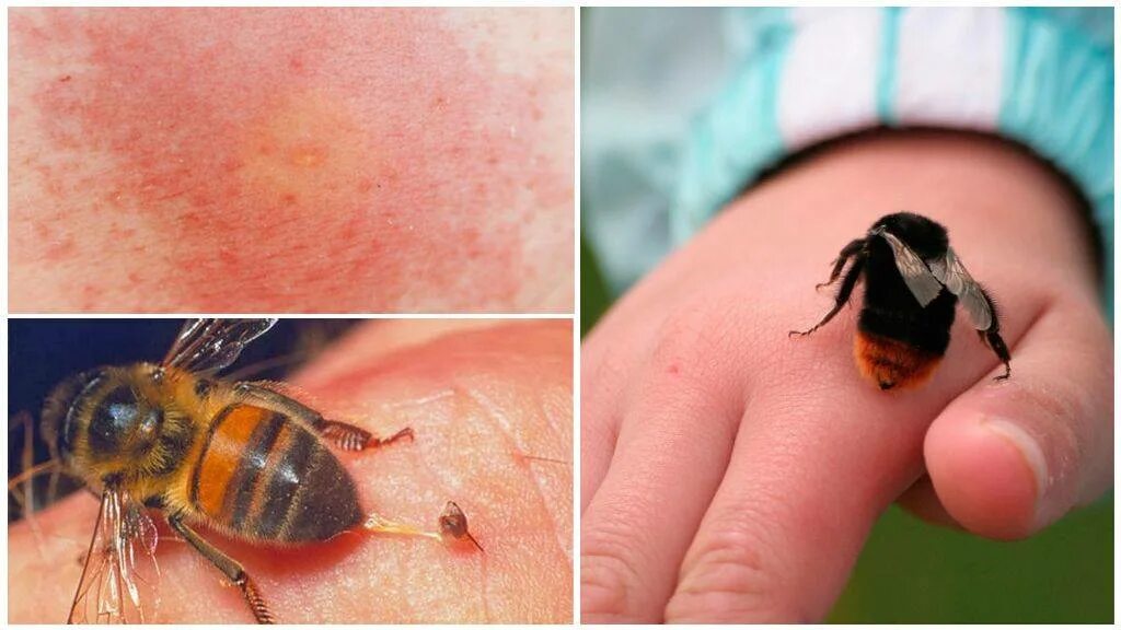 Шмель пчела оса шершень. Осы в теле человека. Пчела овод шершень оса. Шмель пчела оса шершень жалит. Осы в теле человека.