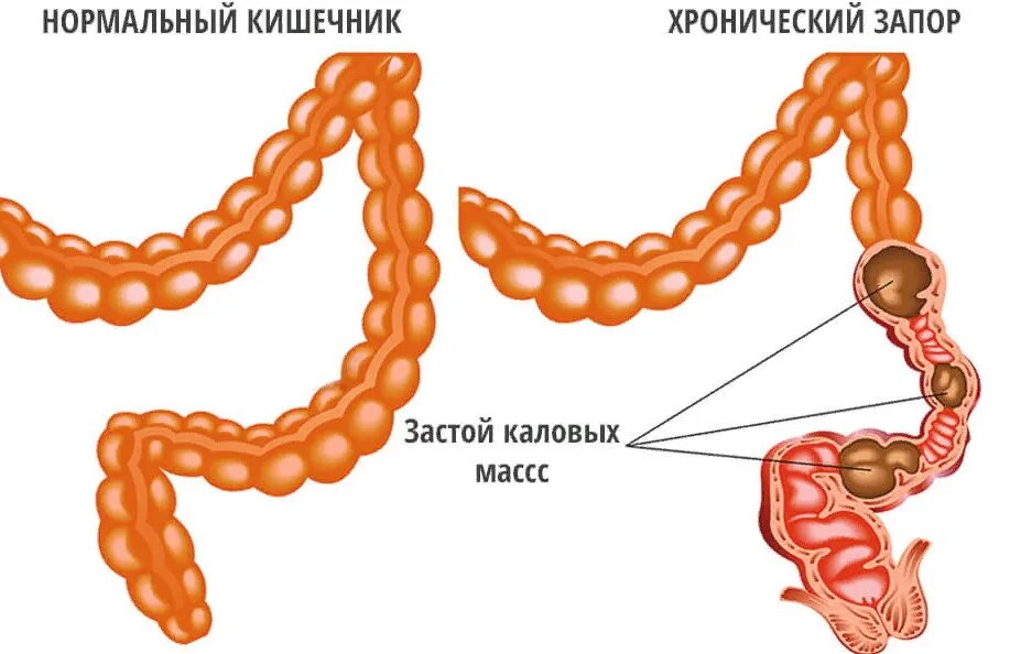 Запор. Хронический запор.