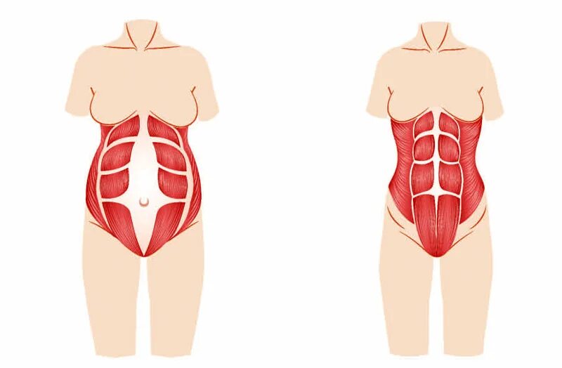 Прямая мышца живота у женщин. Ослабление мышц живота. Мышцы живота у женщин.