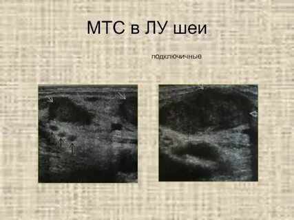 Мтс лимфоузлов